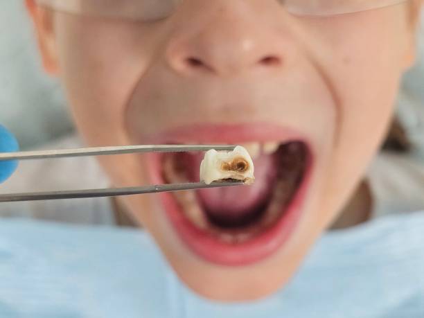 Best Emergency Root Canal Treatment in Five Points, FL