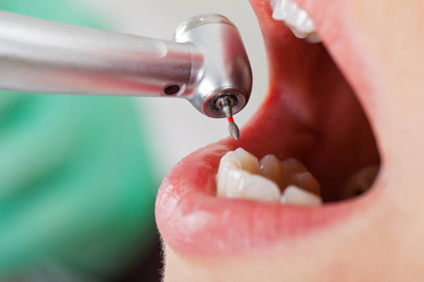 Best Emergency Tooth Extraction in Five Points, FL